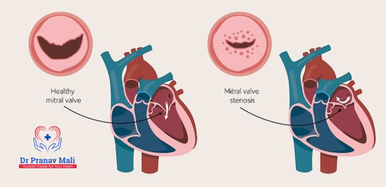 Best Heart Surgeon in Nashik