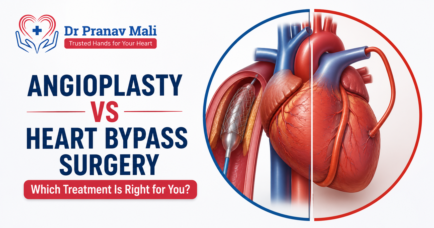 Angioplasty vs Heart Bypass Surgery blog banner featuring Dr. Pranav Mali's logo with a heart care illustration, optimized for the keyword Heart Bypass Specialist.