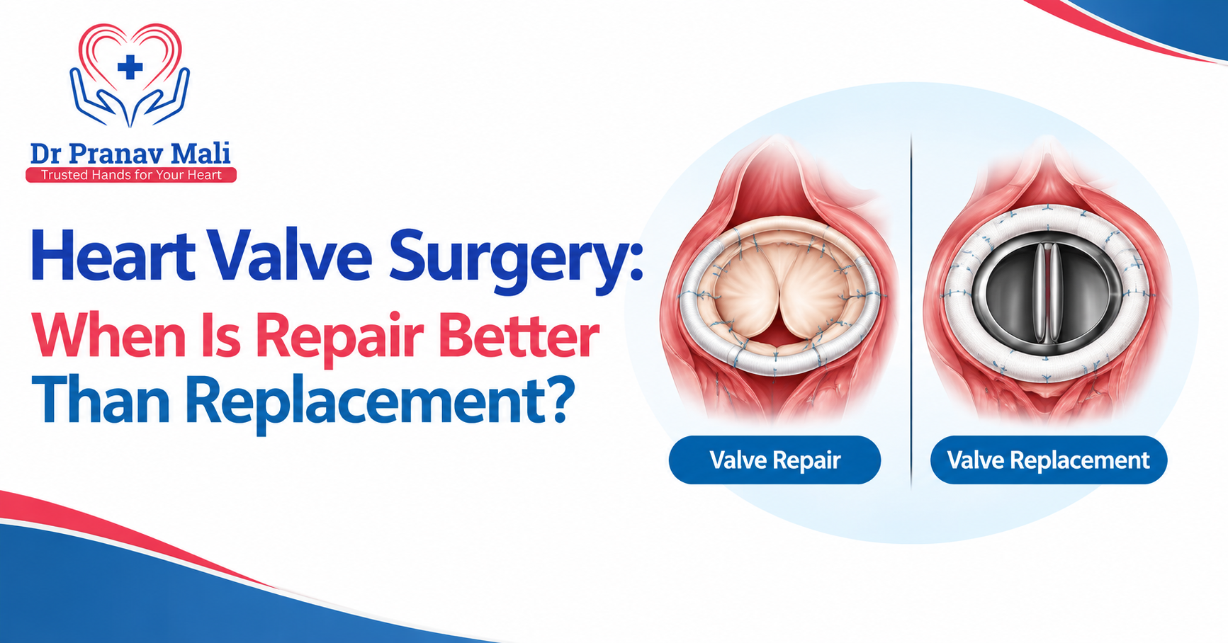 Medical illustration comparing heart valve repair and replacement, showing repaired valve tissue and an artificial replacement valve.